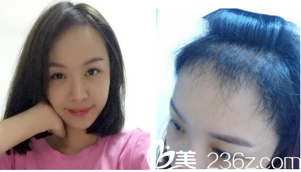 發(fā)際線種植后兩個(gè)月的樣子 發(fā)際線種植后兩個(gè)月的樣子