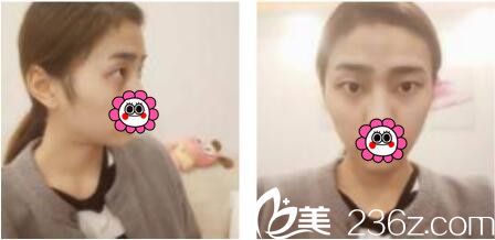 韓國娜美整形外科醫(yī)院高惠園眼綜合真人案例術(shù)前照 韓國娜美整形外科醫(yī)院高惠園眼綜合真人案例術(shù)前照