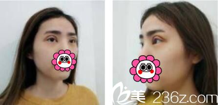 韓國娜美整形外科醫(yī)院高惠園眼綜合真人案例術(shù)后第七天 韓國娜美整形外科醫(yī)院高惠園眼綜合真人案例術(shù)后第七天