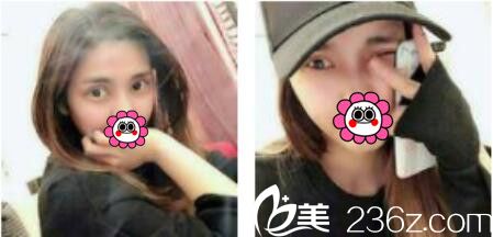 韓國娜美整形外科醫(yī)院高惠園眼綜合真人案例術(shù)后二十一天 韓國娜美整形外科醫(yī)院高惠園眼綜合真人案例術(shù)后二十一天