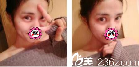 一個月之前去韓國娜美找高惠園做了眼綜合，術后雙眼皮看著十分自然就是還需要忌口