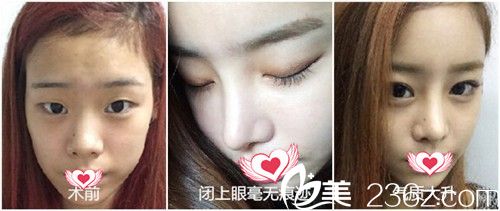 齊向暉院長做埋線雙眼皮案例 齊向暉院長做埋線雙眼皮案例