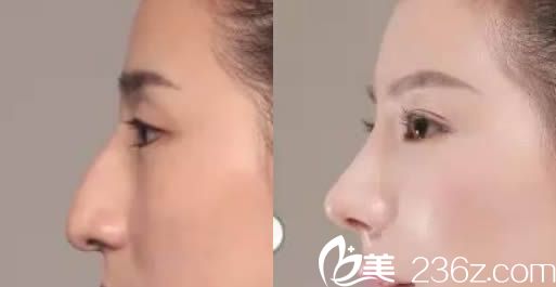 貴陽(yáng)美貝爾整形醫(yī)院假體隆鼻案例圖