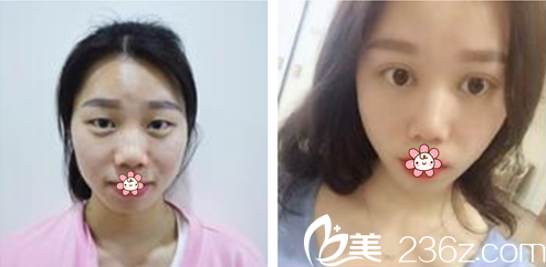 姜哲旭院長雙眼皮案例