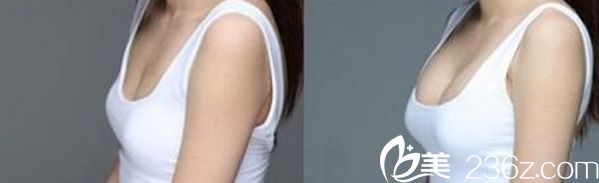 吉基賢院長(zhǎng)自體隆胸效果案例