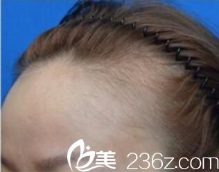 韓國洪承哲整形外科洪承哲發(fā)際線種植真人案例術(shù)前照 韓國洪承哲整形外科洪承哲發(fā)際線種植真人案例術(shù)前照