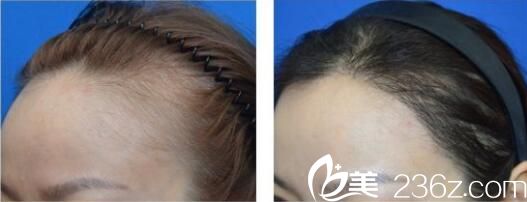 韓國洪承哲整形外科洪承哲發(fā)際線種植真人案例術(shù)前術(shù)后對比 韓國洪承哲整形外科洪承哲發(fā)際線種植真人案例術(shù)前術(shù)后對比