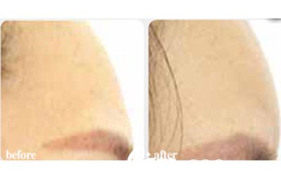 韓國(guó)延世羅姿麗整形醫(yī)院豐額頭案例