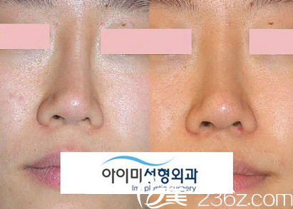韓國(guó)愛(ài)美(IMI)整形醫(yī)院歪鼻矯正案例對(duì)比圖 韓國(guó)愛(ài)美(IMI)整形醫(yī)院歪鼻矯正案例對(duì)比圖