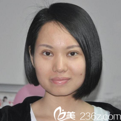 深圳富華切開雙眼皮七天拆線效果圖 深圳富華切開雙眼皮七天拆線效果圖