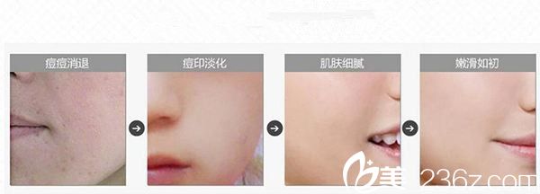 黃珉孝院長(zhǎng)分享激光去痘印后的注意事項(xiàng) 黃珉孝院長(zhǎng)分享激光去痘印后的注意事項(xiàng)