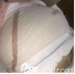 在<!--<i data=20240703-sp></i>-->做脂肪豐胸第2天效果 在<!--<i data=20240703-sp></i>-->做脂肪豐胸第2天效果