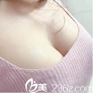 <!--<i data=20240703-sp></i>-->脂肪豐胸案例第31天效果 <!--<i data=20240703-sp></i>-->脂肪豐胸案例第31天效果