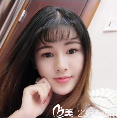 <!--<i data=20240703-sp></i>-->整形醫(yī)院陳瑞紅面部線雕提升兩個(gè)月效果圖