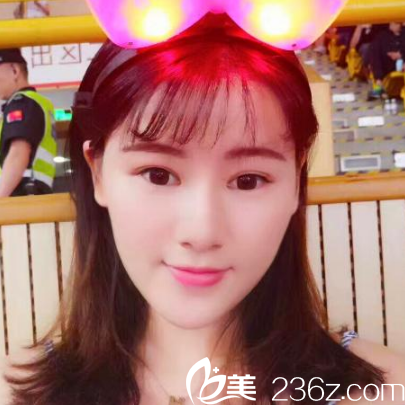 在<!--<i data=20240703-sp></i>-->整形醫(yī)院做完線雕埋線提升三個(gè)月了