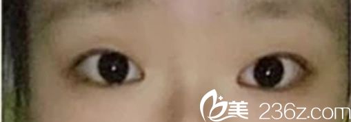 Channel整形醫(yī)院手術前 Channel整形醫(yī)院手術前