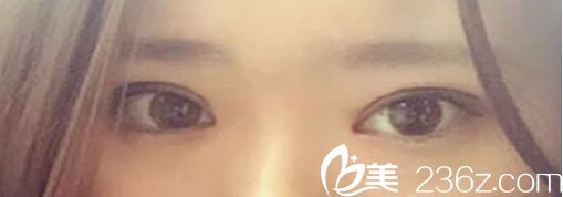 雙眼皮+內(nèi)開眼角術后效果 雙眼皮+內(nèi)開眼角術后效果
