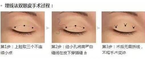 美萊美容醫(yī)院楊繼紅埋線雙眼皮 美萊美容醫(yī)院楊繼紅埋線雙眼皮