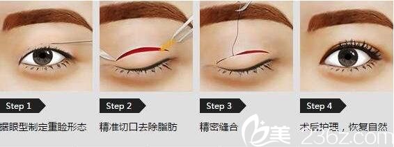 美萊美容醫(yī)院楊繼紅切開雙眼皮 美萊美容醫(yī)院楊繼紅切開雙眼皮