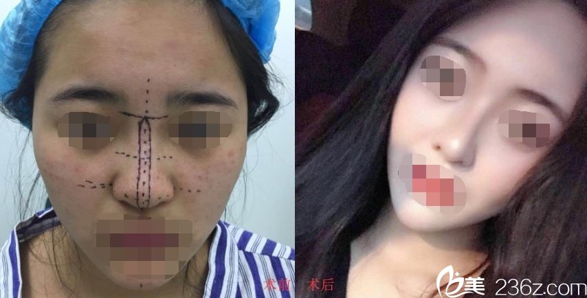 杜亞如醫(yī)生鼻綜合案例 杜亞如醫(yī)生鼻綜合案例