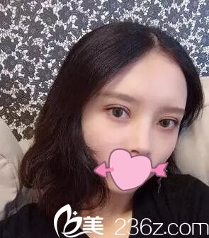 兩個月前我面診了錦州斯美諾整形醫(yī)院耿成虎和周杰后我選擇耿成虎做了全切雙眼皮
