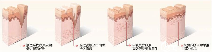 美萊美容醫(yī)院黃夢婷祛痘方法 美萊美容醫(yī)院黃夢婷祛痘方法