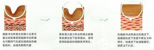 美萊美容醫(yī)院黃夢婷祛痘原理 美萊美容醫(yī)院黃夢婷祛痘原理