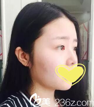 假體隆鼻術(shù)前照 假體隆鼻術(shù)前照