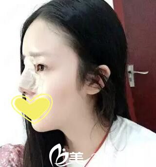 錦州斯美諾鼻整形第三天 錦州斯美諾鼻整形第三天