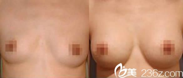 韓國瑞姿整形醫(yī)院崔載英院長隆胸案例圖 韓國瑞姿整形醫(yī)院崔載英院長隆胸案例圖