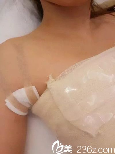 隆胸手術(shù)后2天 隆胸手術(shù)后2天