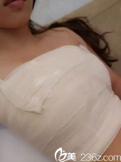 隆胸手術(shù)后6天 隆胸手術(shù)后6天