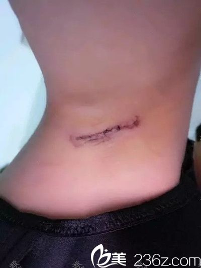 腋下切口恢復(fù)情況 腋下切口恢復(fù)情況