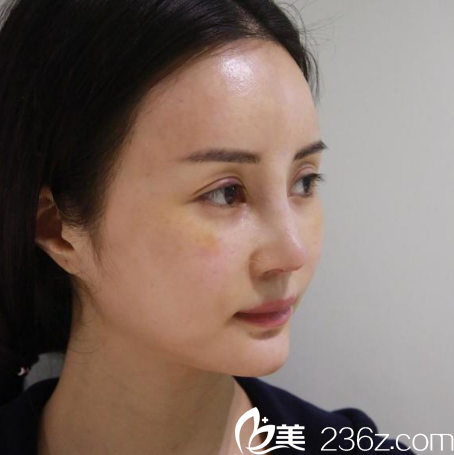 找廣州紫馨金孝憲院長做完鼻綜合隆鼻七天效果圖