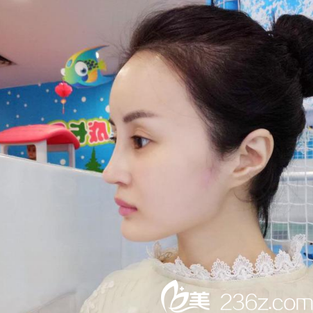 廣州紫馨金孝憲院長為我做的隆鼻隆鼻和脂肪填充半個(gè)月自拍照片