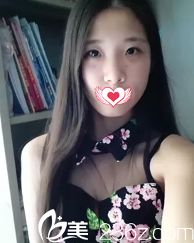 大家都感覺腫泡眼蛻變魅惑電眼非常難 但我找王金州做切開雙眼皮術(shù)后26天就實現(xiàn)了