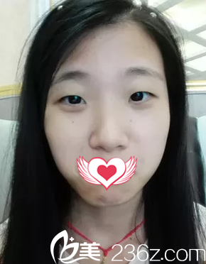 術(shù)前單眼皮小眼睛 術(shù)前單眼皮小眼睛