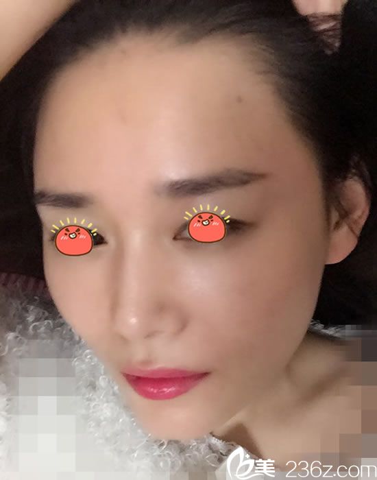 脂肪填充好神奇,找寧波童顏整形院長做了全臉脂肪填充后感覺年輕了好多