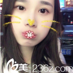 雙眼皮修復(fù)數(shù)不勝數(shù)，真慶幸自己在遵義利美康唐明芳那兒做的雙眼皮成功了！