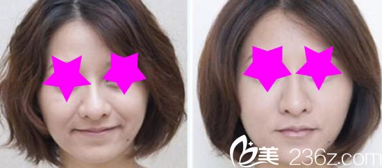 Channel整形醫(yī)院面部除皺前后效果 Channel整形醫(yī)院面部除皺前后效果