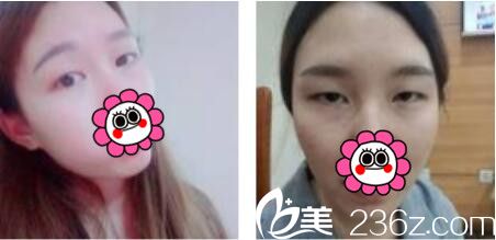 韓國(guó)黃金比整形外科金明國(guó)雙眼皮真人案例術(shù)前照 韓國(guó)黃金比整形外科金明國(guó)雙眼皮真人案例術(shù)前照