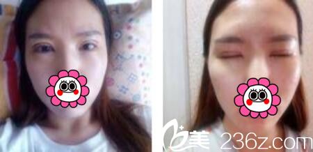 韓國(guó)黃金比整形外科金明國(guó)雙眼皮真人案例術(shù)后第三天 韓國(guó)黃金比整形外科金明國(guó)雙眼皮真人案例術(shù)后第三天