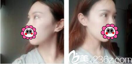 韓國(guó)黃金比整形外科金明國(guó)雙眼皮真人案例術(shù)后第七天 韓國(guó)黃金比整形外科金明國(guó)雙眼皮真人案例術(shù)后第七天