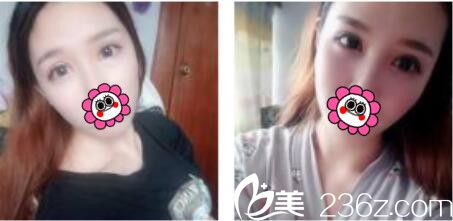 韓國(guó)黃金比整形外科金明國(guó)雙眼皮真人案例術(shù)后十八天 韓國(guó)黃金比整形外科金明國(guó)雙眼皮真人案例術(shù)后十八天