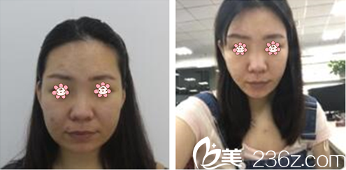 PARK SUNG GEO院長面部輪廓案例 PARK SUNG GEO院長面部輪廓案例