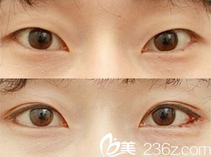 李重根眼綜合真人案例對比