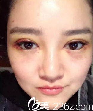 術(shù)后天我眼睛很腫不過(guò)線條很完美