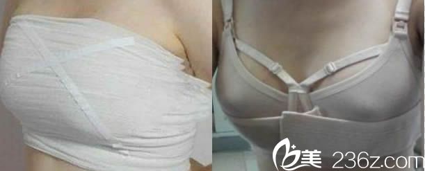 韓國(guó)瑞姿整形隆胸后穿塑胸內(nèi)衣圖 韓國(guó)瑞姿整形隆胸后穿塑胸內(nèi)衣圖