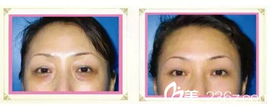 胡在春院長去眼袋案例 胡在春院長去眼袋案例