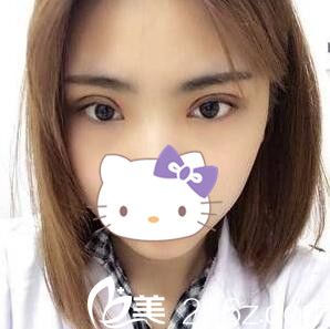 李重根做的雙眼皮術(shù)后第三天 李重根做的雙眼皮術(shù)后第三天